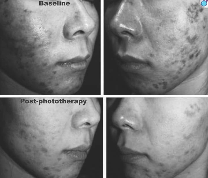 Fototerapia LED (LLLT): qué es, cómo actúa en tu piel y qué dice la ciencia