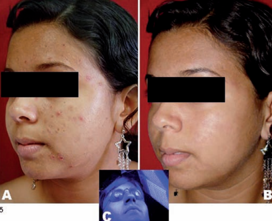 Terapia Fotodinámica (PDT): qué es, cómo funciona y qué beneficios tiene en la piel